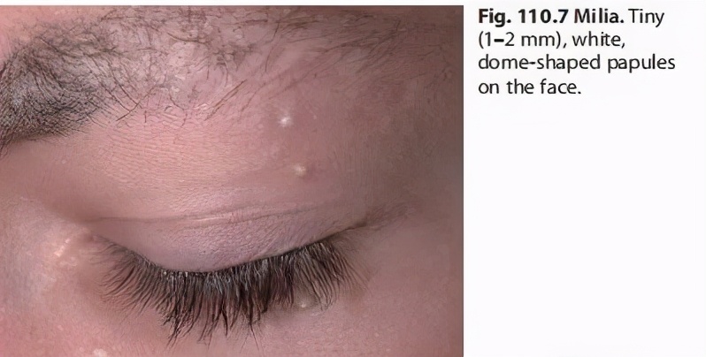 脸上长了闭口小颗粒怎么去除,脸上长白色小颗粒怎样去除掉
