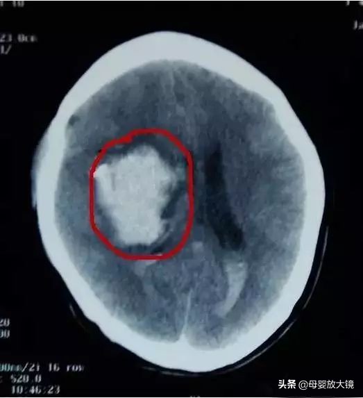 宝宝摔到头导致脑损伤,宝宝学走路摔了后脑