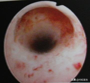 剖宫产后2年B超发现子宫里面出了“套间”,影响我要二宝吗?