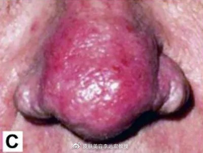 酒渣鼻有什么特效药,酒渣鼻的原因及治疗