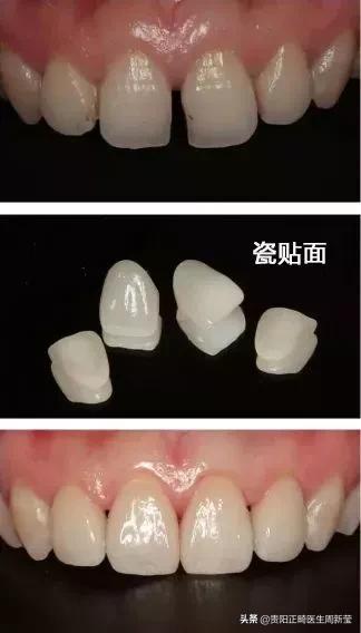 牙缝大吃东西老是塞牙怎么解决,牙缝大吃东西塞牙怎么补救最快