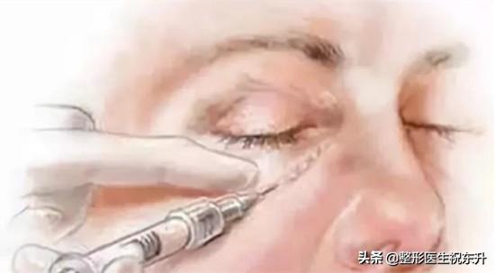 面部提拉可以改善泪沟嘛,做完面部提升手术