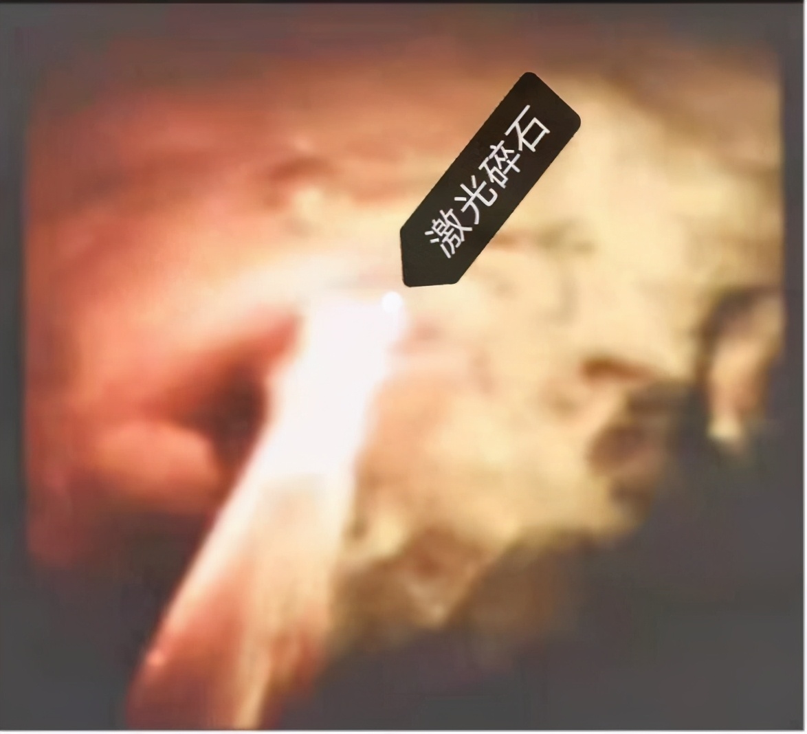 精益求精镜亦求净哈医大一院消化内科ERCP下取净胆管内2.5cm巨型结石