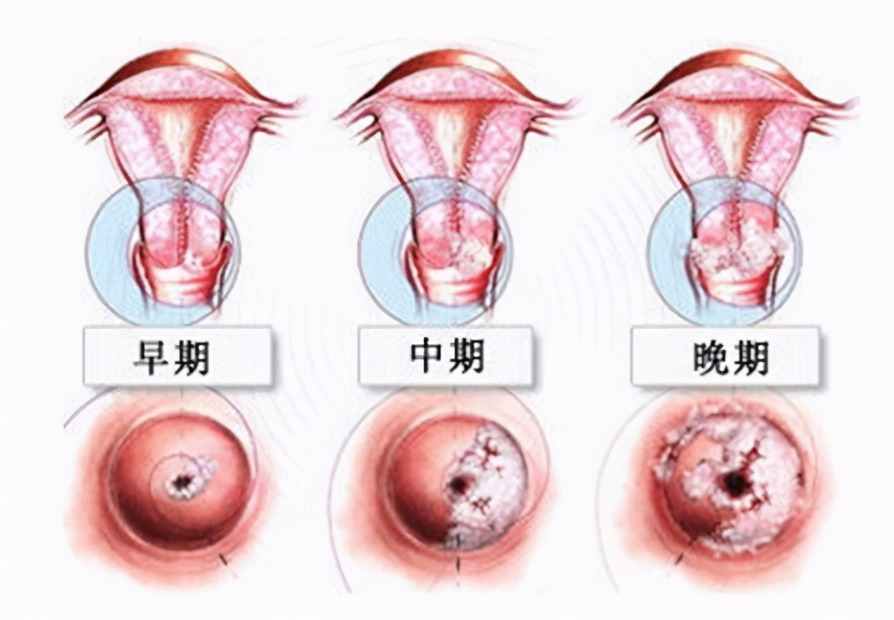 宫颈糜烂不用治？宫颈糜烂能自行恢复吗？医生辟谣来了