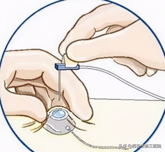 输液港堵了多久能通开,如何避免输液港堵管