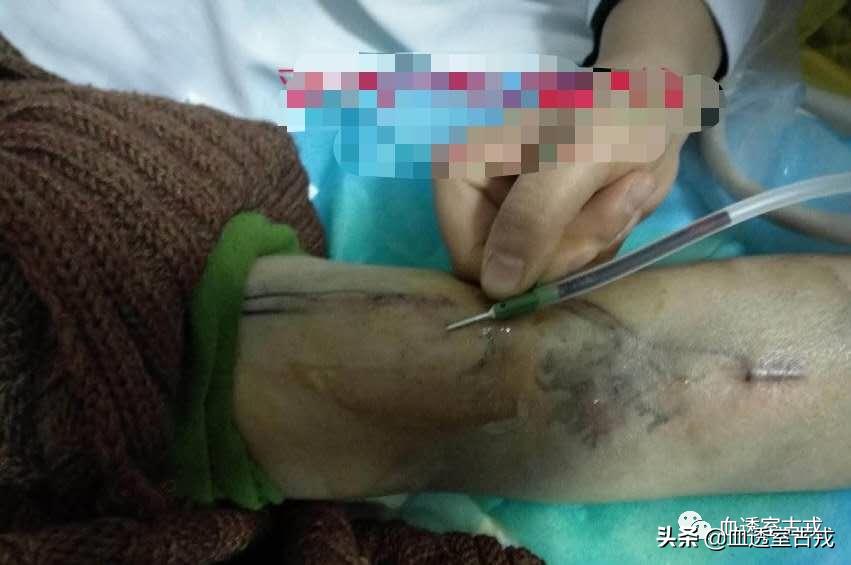 内瘘血肿,穿刺后皮下血肿怎么处理