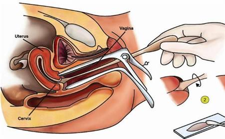 居民常见恶性肿瘤筛查和预防推荐,女人常见的肿瘤
