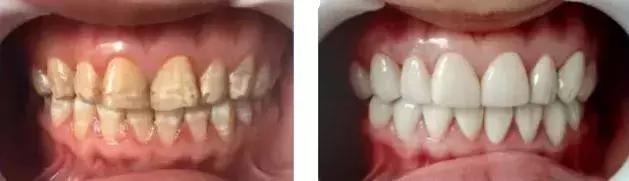 牙白一度颜值瞬间升三度,牙齿白有多重要