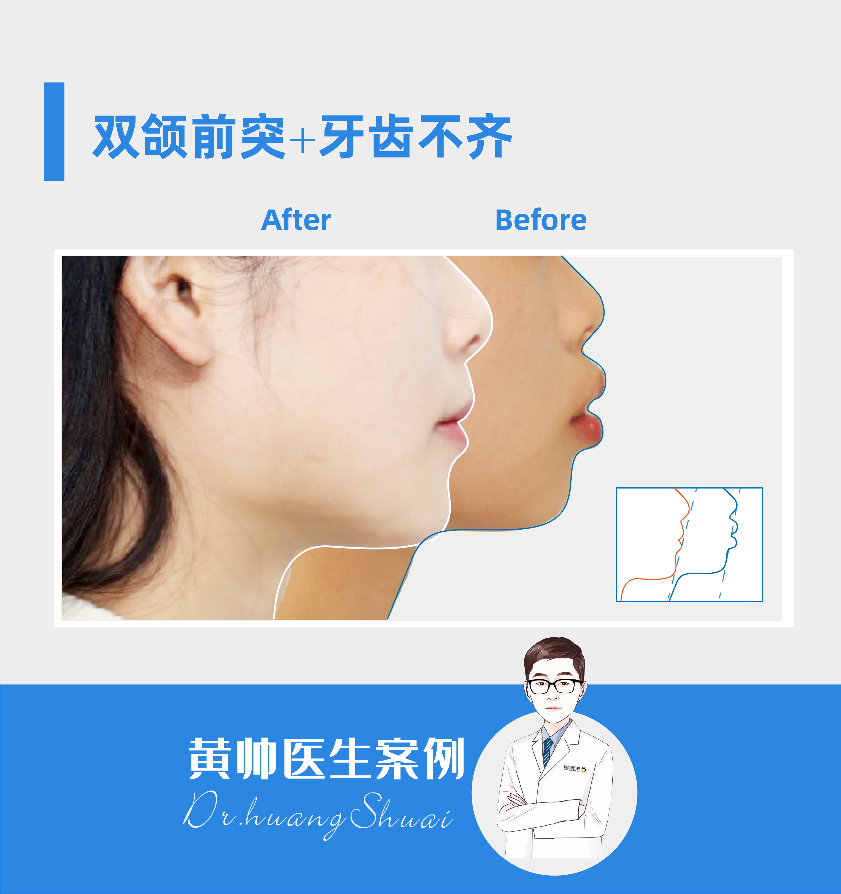 嘴凸牙齿矫正前后对比视频,牙齿矫正拔智齿可以怎样改善嘴凸