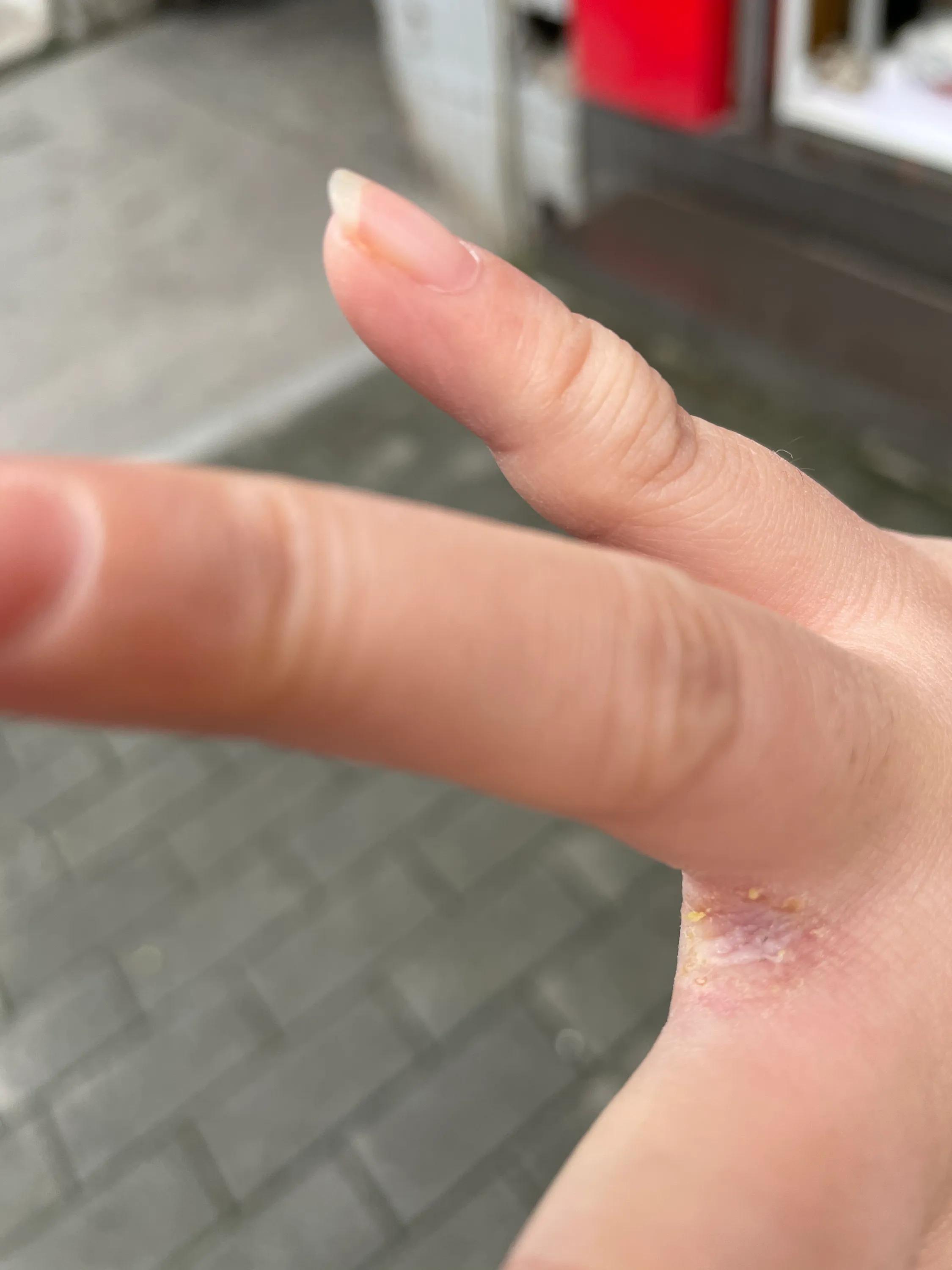 养猫经验猫得了猫癣怎么办,养猫后人得了体癣怎么办