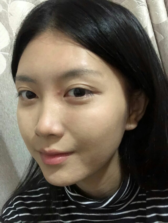 鼻子很高很挺的隆鼻案例,3万元左右的隆鼻效果图