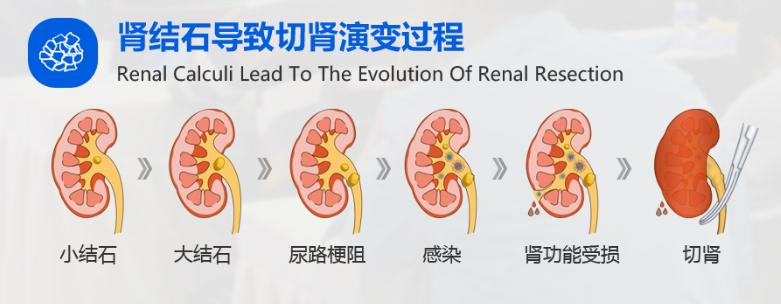做完体外碎石为什么总大便,体外碎石后出现结石的原因