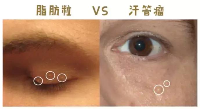 老中医教你一招彻底解决脂肪粒,肚子里面有脂肪粒怎么解决