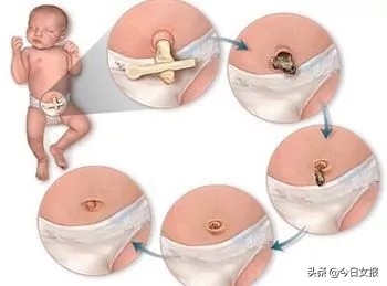 新生儿脐带被剪后化脓,新生儿脐带掉了肚脐渗血怎样处理