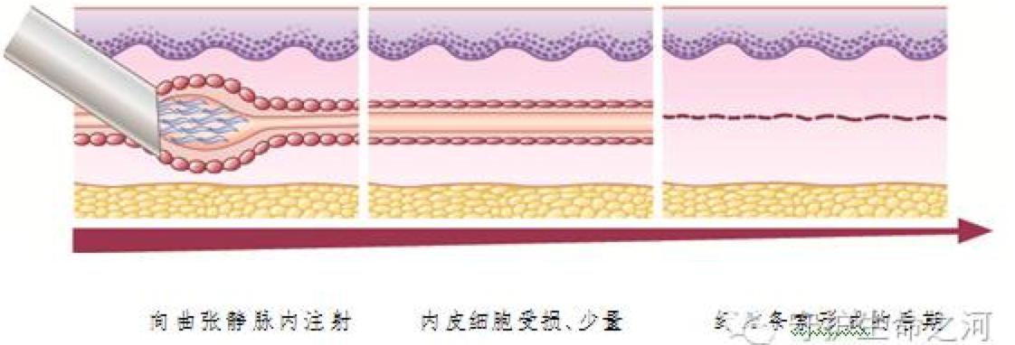 隔壁老王说静脉曲张可以打针治疗!这是真的吗?