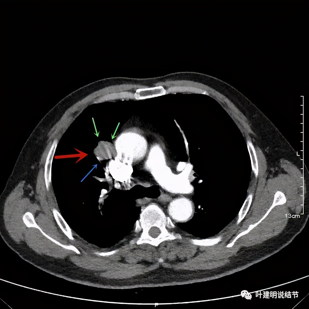 误诊报告图片,误诊案例及案例分析