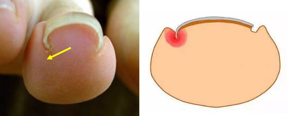 甲沟炎脚趾甲长到肉里,脚趾甲长到肉里很疼怎么处理