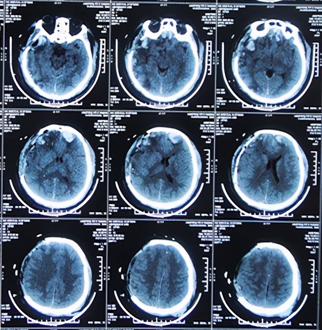 脑外伤开颅手术后脑积水,脑外伤手术后脑脊液鼻漏怎么治疗