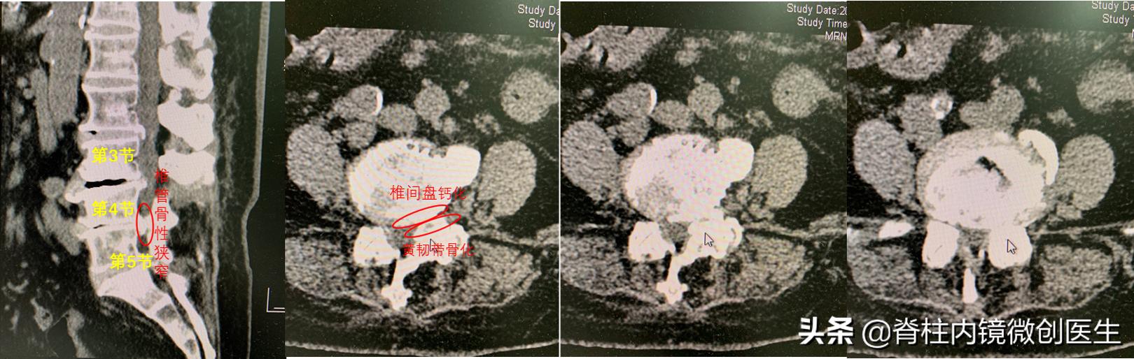 老年腰椎管狭窄的手术治疗,微创手术治疗腰椎管狭窄的技术