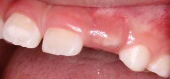 10岁孩子牙掉1年还不长,孩子不长牙了怎么办