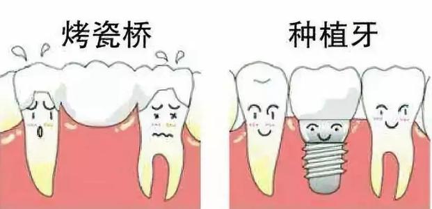 种植牙和烤瓷牙究竟有哪些区别?为什么都说种植牙好?
