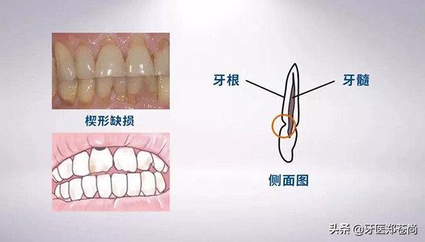牙齿楔形磨损怎么补救,牙齿楔形缺损怎么处理
