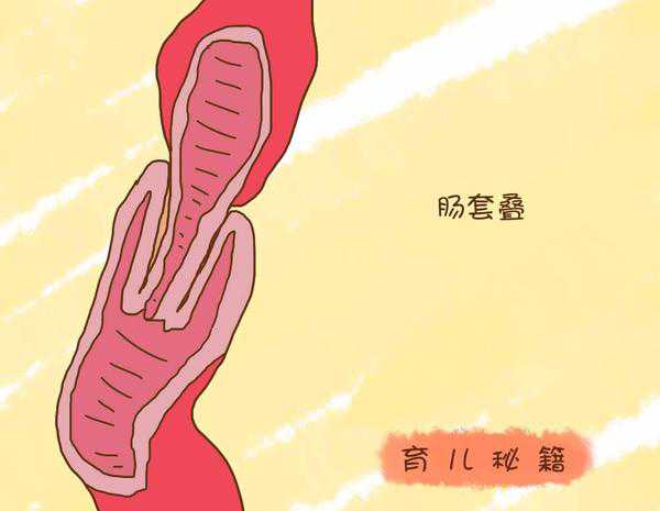 宝宝间断性哭闹是肠套叠吗,宝宝肠绞痛会一直哭闹吗