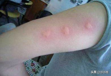 夏天蚊子不近身有什么方法,躲避蚊子最有效的方法