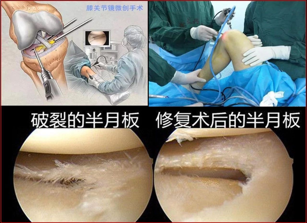 善待你的半月板,善待膝关节珍惜半月板