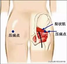 老年人常见的髋部损伤有哪些,跑步的常见损伤之髋关节