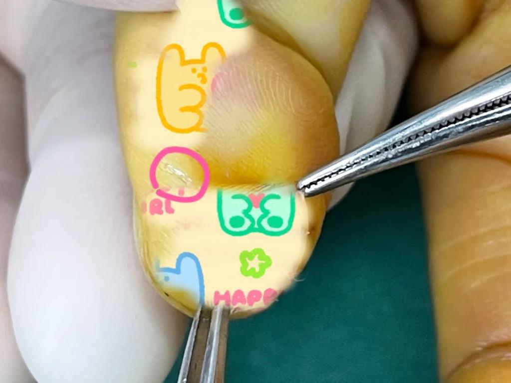 手机钢化膜碎了没及时换碎片扎进手指刺伤了骨头还造成了神经瘤|大美女相亲屡受挫问题出在鼻子上