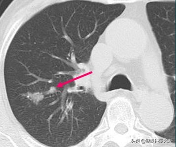 这5种癌一发现就是晚期,第一例癌症患者治愈