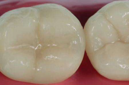 北京精德口腔,北京口腔医院补牙用的什么树脂