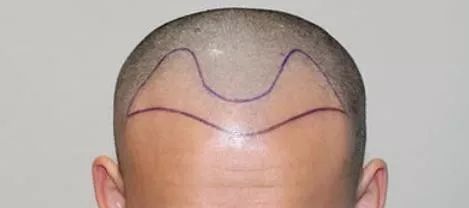 m型脱发临床诊断怎么写,m型脱发最新研究