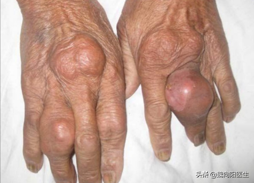 为什么饮食规律还能得痛风,没有喝酒没有吃肉为啥痛风犯了呢