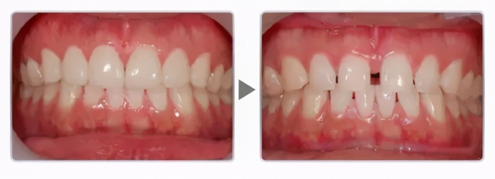 牙齿收缝为什么门牙缝隙越来越大,儿童门牙缝隙越来越大原因