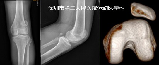 髌骨半脱位关节镜微创手术,髌骨脱位二联手术