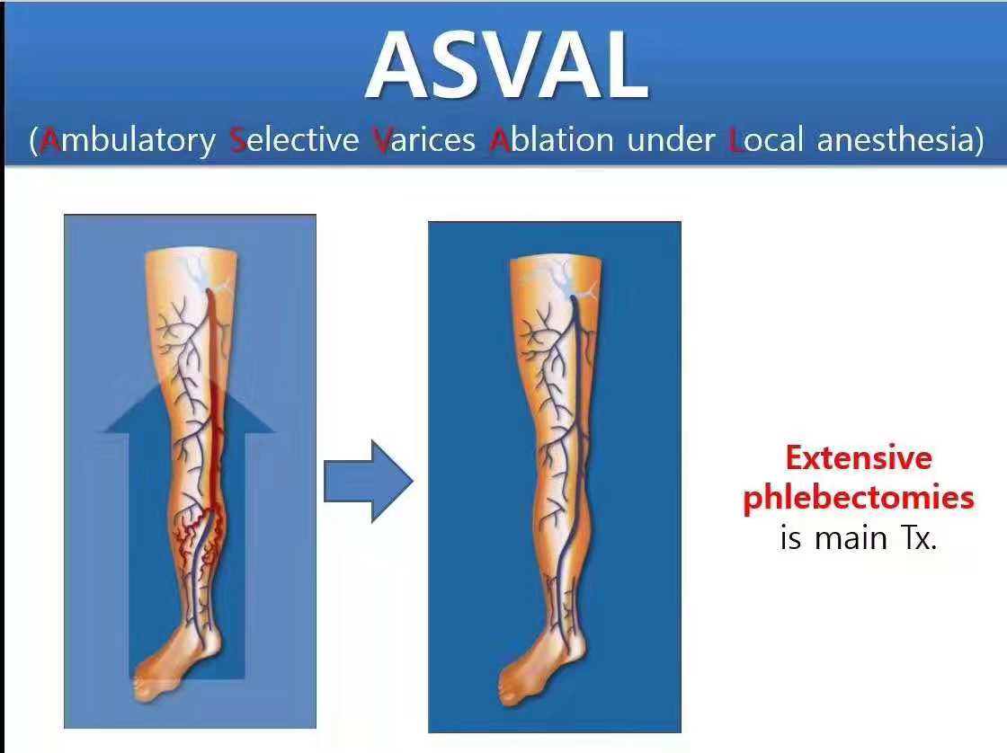如何治疗静脉曲张蚯蚓腿 (静脉曲张术后蚯蚓多久消失)