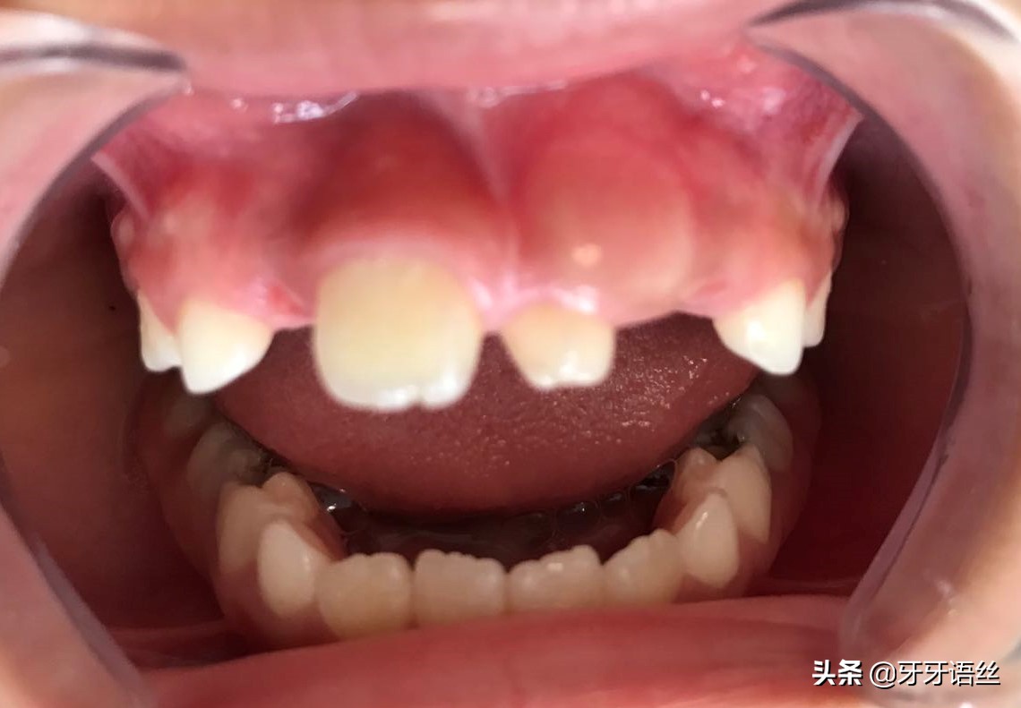 儿童龋齿的病因及预防诊治