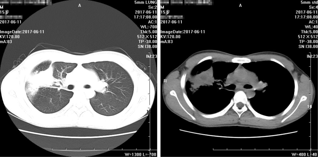 如何在CAP初始治疗后72h内进行病情评价?其成功关键有哪些?