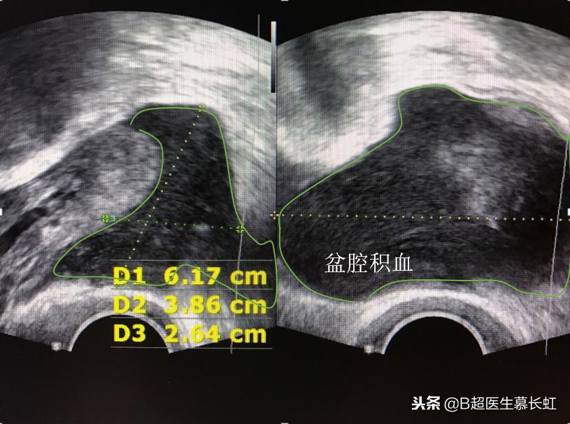 月经前期有盆腔积液小肚子痛,男孩盆腔积液会导致肚子痛吗