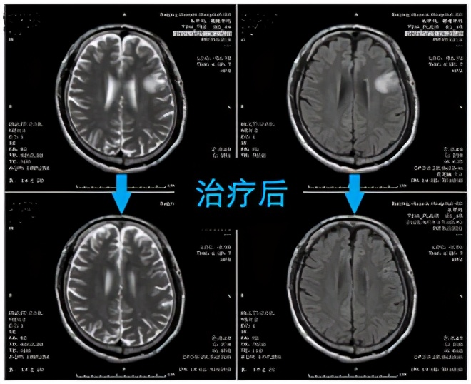 迷雾追踪迅驰,脑囊虫为什么会潜伏几十年
