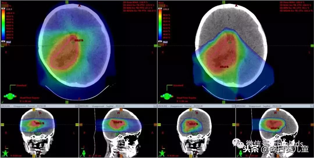 质子治肿瘤怎么样,儿童肿瘤质子治疗好吗