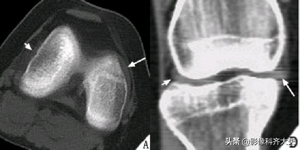 膝关节半月板损伤的磁共振,膝关节半月板病变的mri诊断与鉴别
