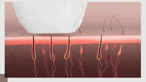 不会脱毛怎么办,怎样选择脱毛仪