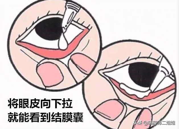 滴眼液的好方法,滴眼液怎么用才正确