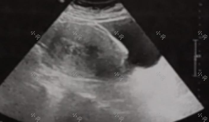 绝经1年后出血伴左腹痛,绝经后一年出血查出子宫内膜癌