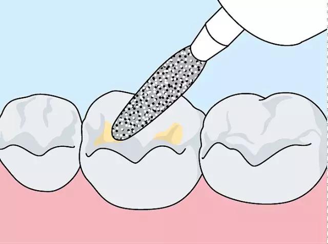 什么是儿童窝沟封闭？会不会痛？1分钟视频带你看懂#雅悦齿科#