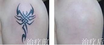 洗纹身健康科普,清洗纹身后需要注意什么