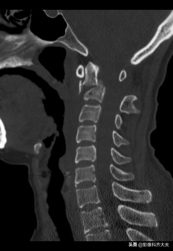 骨折的影像学检查及各自的优势,骨折的影像学愈合标准